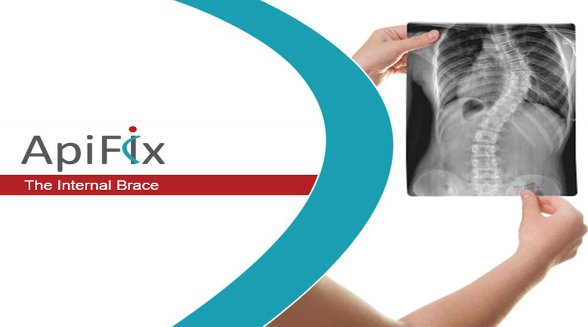 Singapore: Trendlines portfolio firm ApiFix closes $5m Series B investment